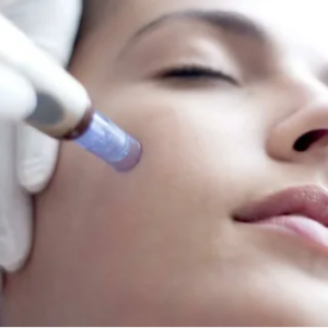 Platelet Rich Plasma with Microneedling (PRP) – Face, Neck, and Chest