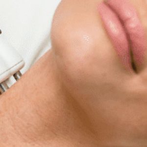 Photo Rejuvenation Neck IPL (50 Min)