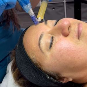 Platelet Rich Plasma w/microneedle (Face, Neck, Chest) - Single Session