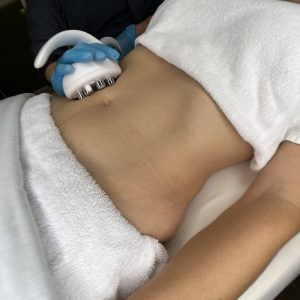 Skin Tightening Abdomen (Pkg 5 Sessions)